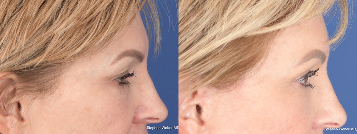Blepharoplasty Before & After Gallery - Patient 172486 - Image 6
