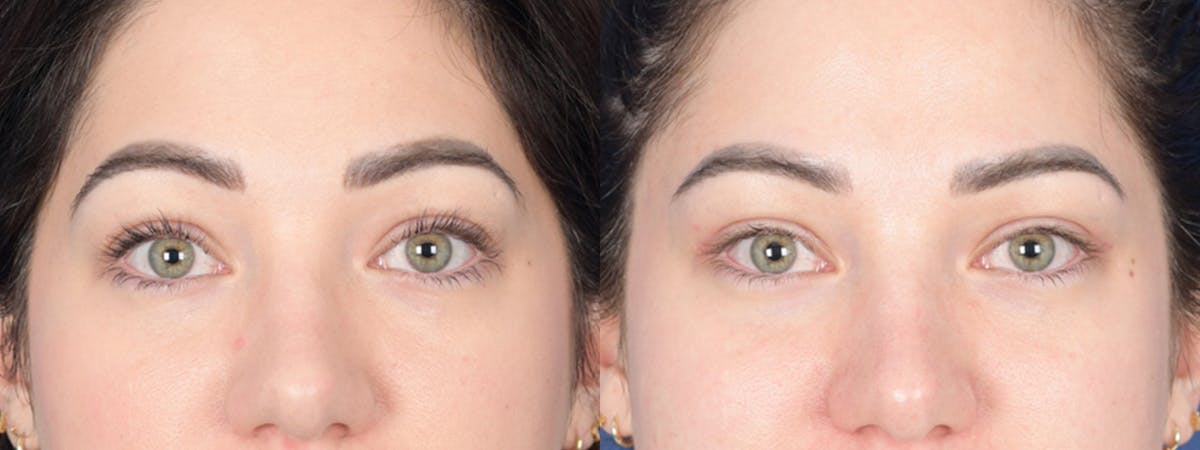 Blepharoplasty Before & After Gallery - Patient 138490 - Image 1