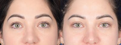 Blepharoplasty Before & After Gallery - Patient 138490 - Image 1