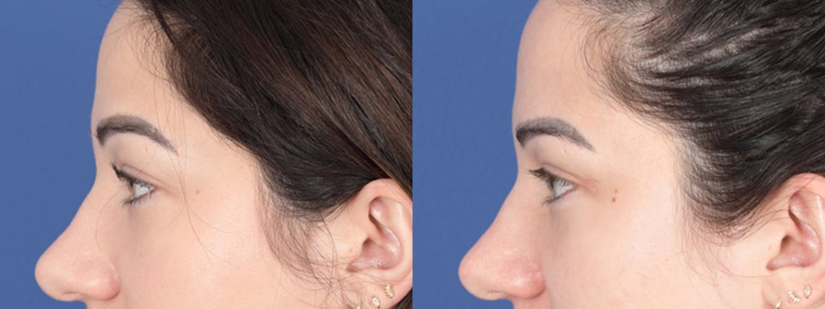 Blepharoplasty Before & After Gallery - Patient 138490 - Image 2