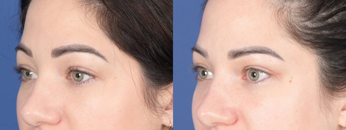 Blepharoplasty Before & After Gallery - Patient 138490 - Image 3