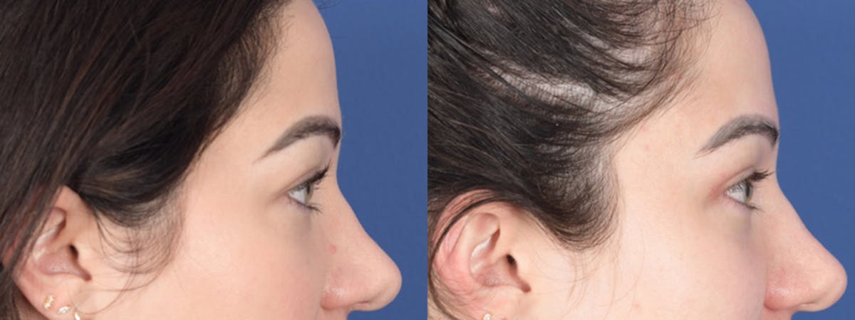 Blepharoplasty Before & After Gallery - Patient 138490 - Image 4