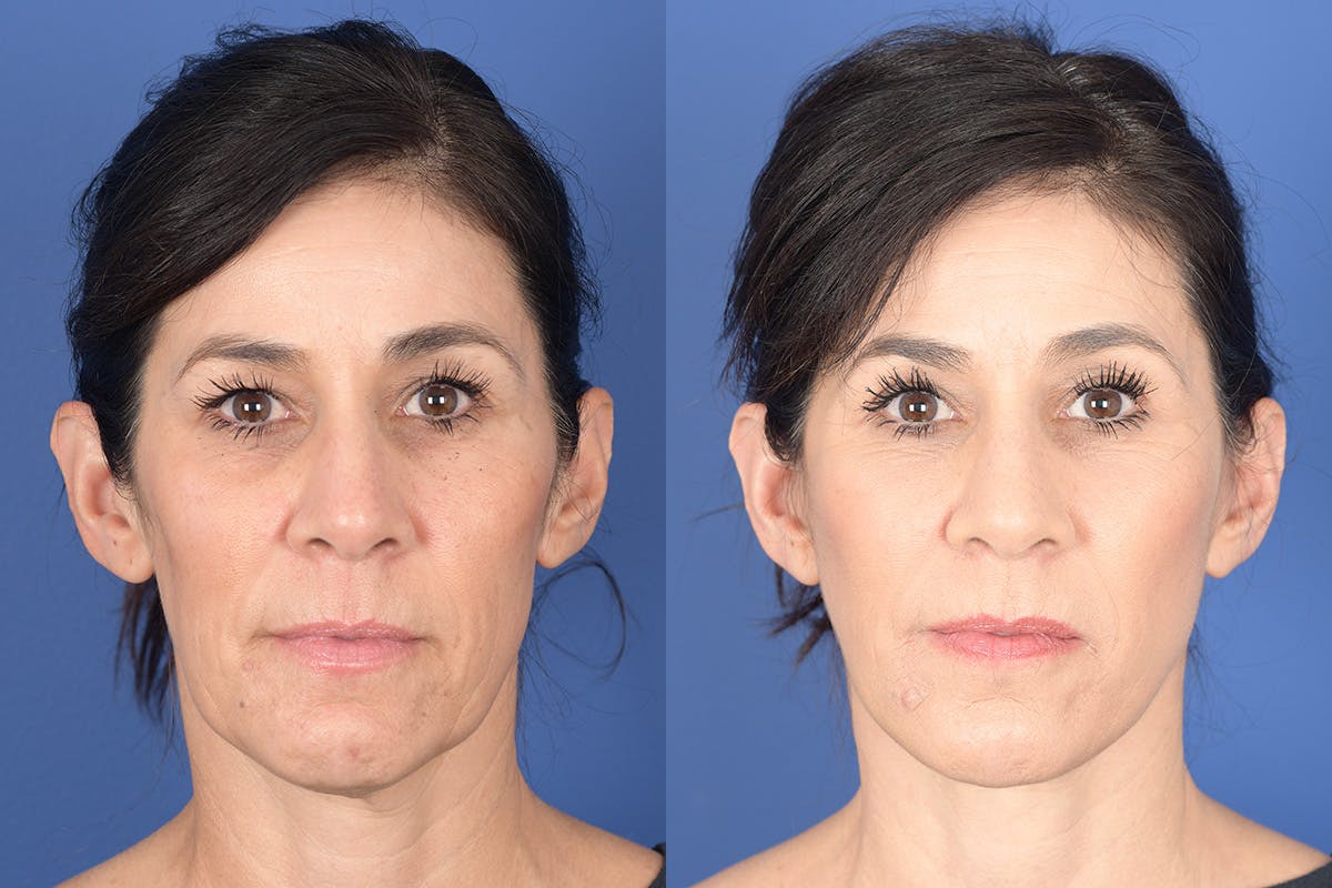Blepharoplasty Before & After Gallery - Patient 189665 - Image 1