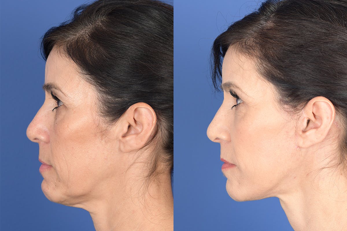 Blepharoplasty Before & After Gallery - Patient 189665 - Image 2