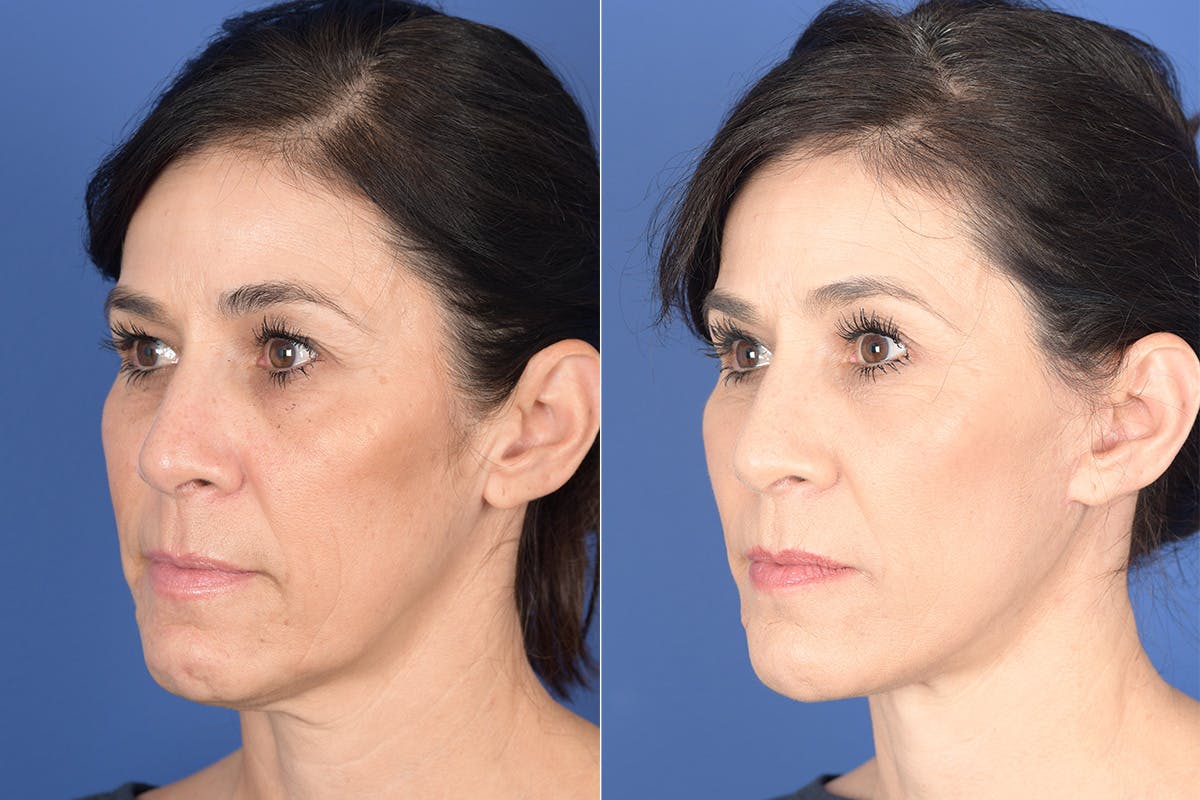 Blepharoplasty Before & After Gallery - Patient 189665 - Image 3