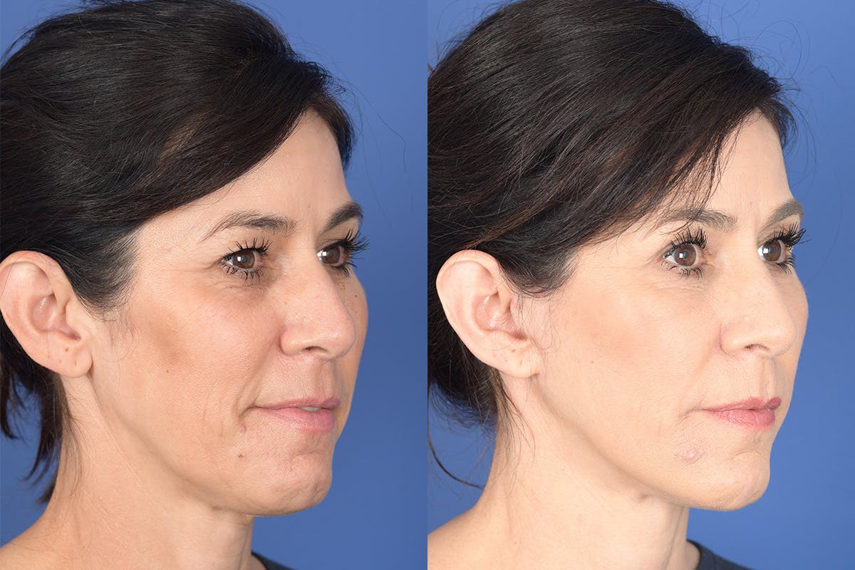 Blepharoplasty Before & After Gallery - Patient 189665 - Image 4