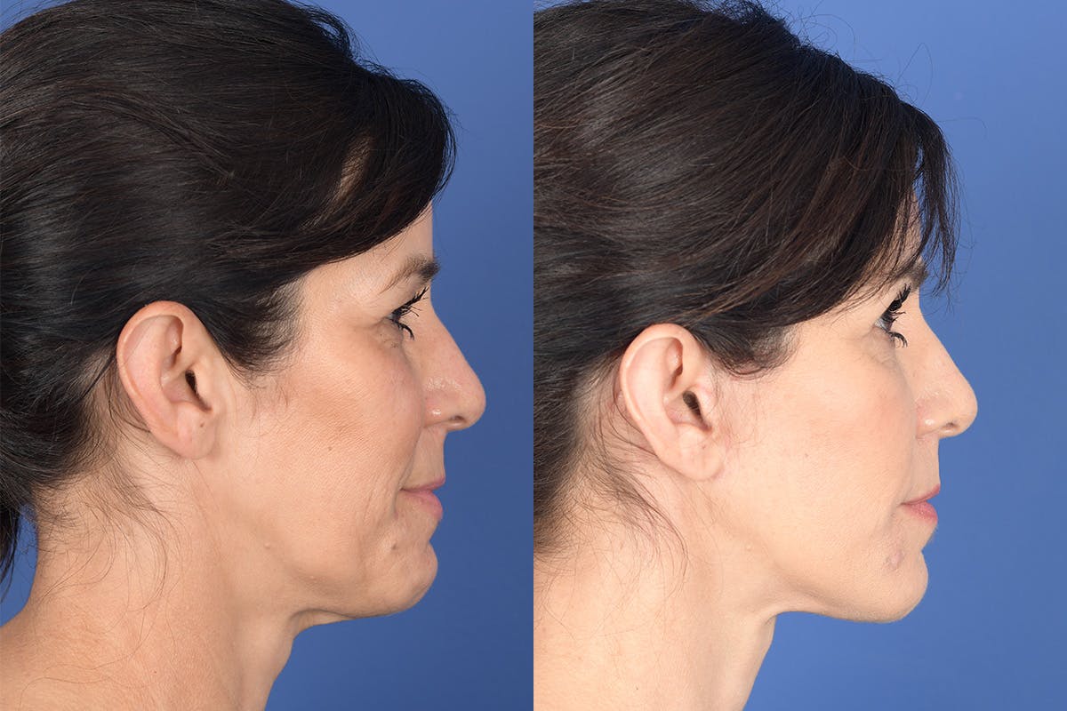 Blepharoplasty Before & After Gallery - Patient 189665 - Image 5