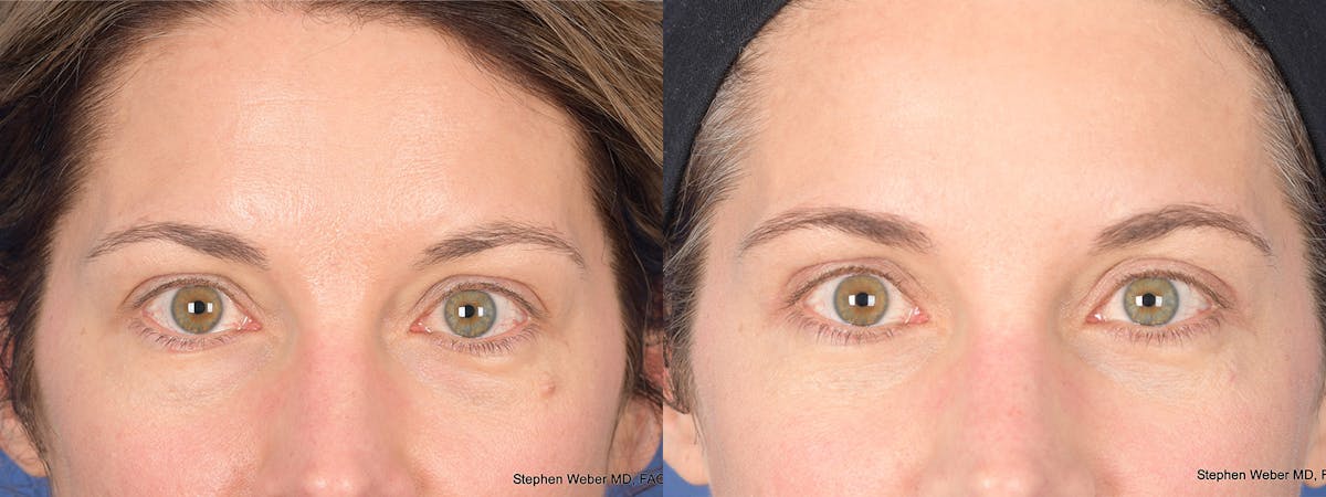 Blepharoplasty Before & After Gallery - Patient 460350 - Image 1