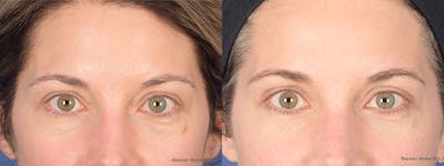 Blepharoplasty Before & After Gallery - Patient 460350 - Image 1