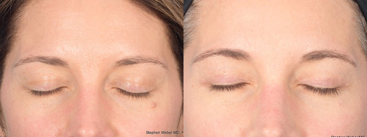 Blepharoplasty Before & After Gallery - Patient 460350 - Image 2