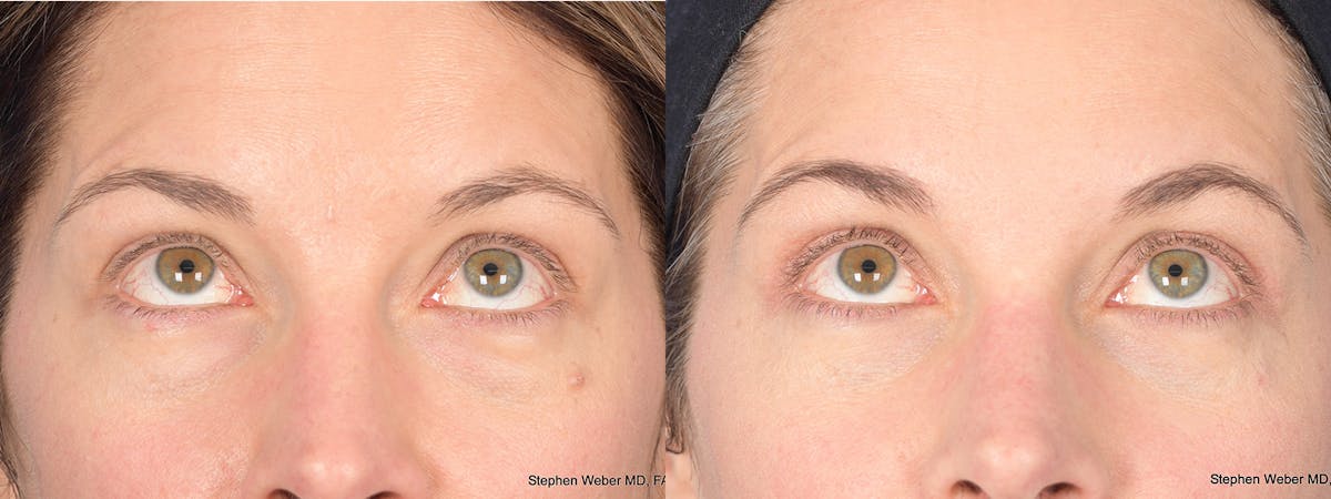 Blepharoplasty Before & After Gallery - Patient 460350 - Image 3