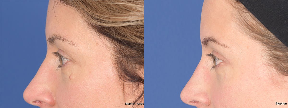 Blepharoplasty Before & After Gallery - Patient 460350 - Image 4