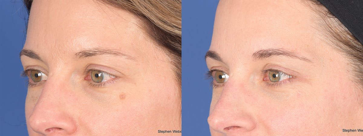 Blepharoplasty Before & After Gallery - Patient 460350 - Image 5