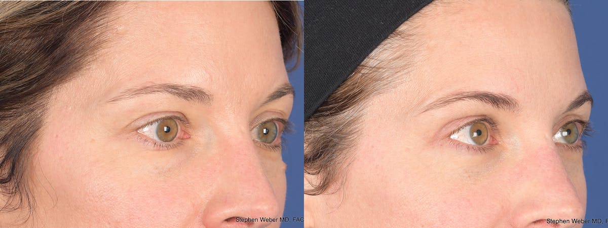 Blepharoplasty Before & After Gallery - Patient 460350 - Image 6