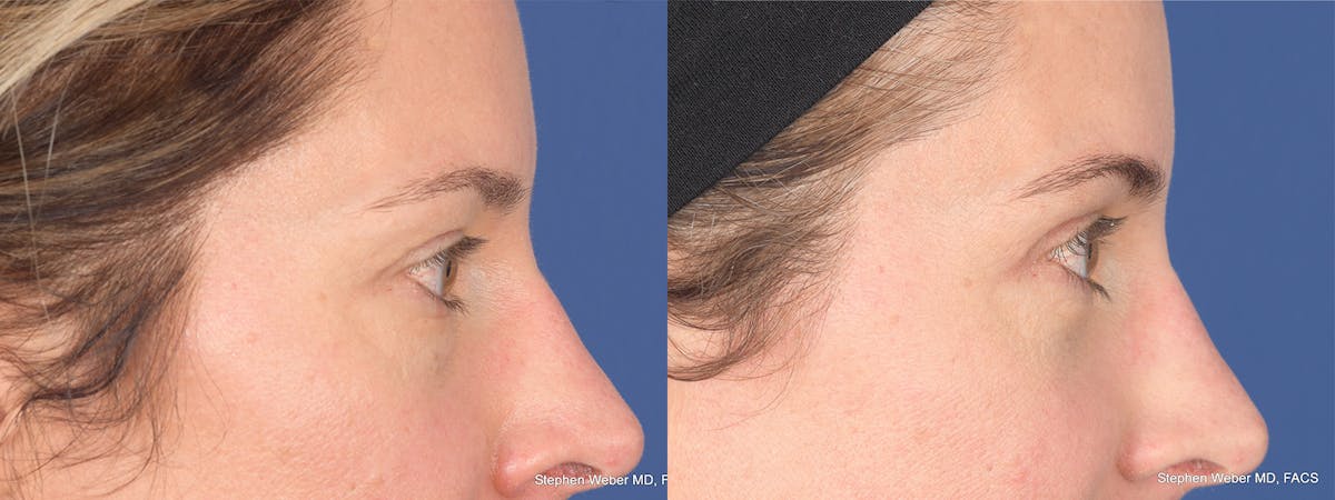 Blepharoplasty Before & After Gallery - Patient 460350 - Image 7