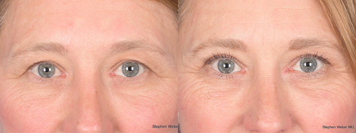 Blepharoplasty Before & After Gallery - Patient 126678 - Image 1