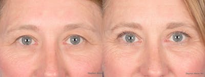Blepharoplasty Before & After Gallery - Patient 126678 - Image 1