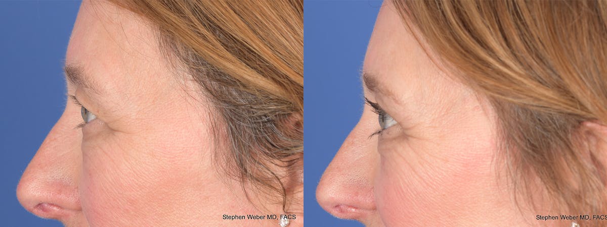 Blepharoplasty Before & After Gallery - Patient 126678 - Image 2