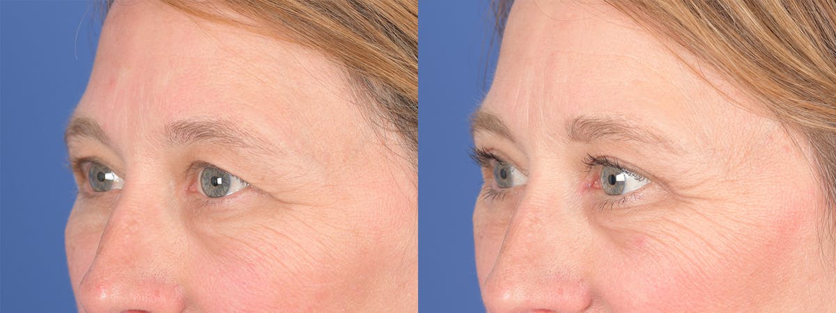 Blepharoplasty Before & After Gallery - Patient 126678 - Image 3
