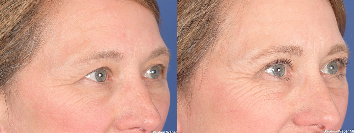 Blepharoplasty Before & After Gallery - Patient 126678 - Image 4