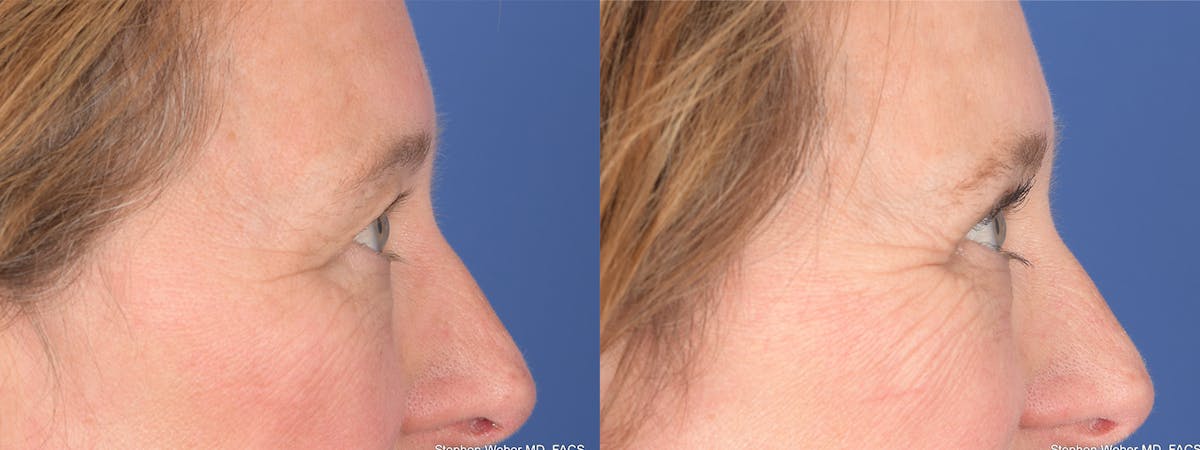 Blepharoplasty Before & After Gallery - Patient 126678 - Image 5