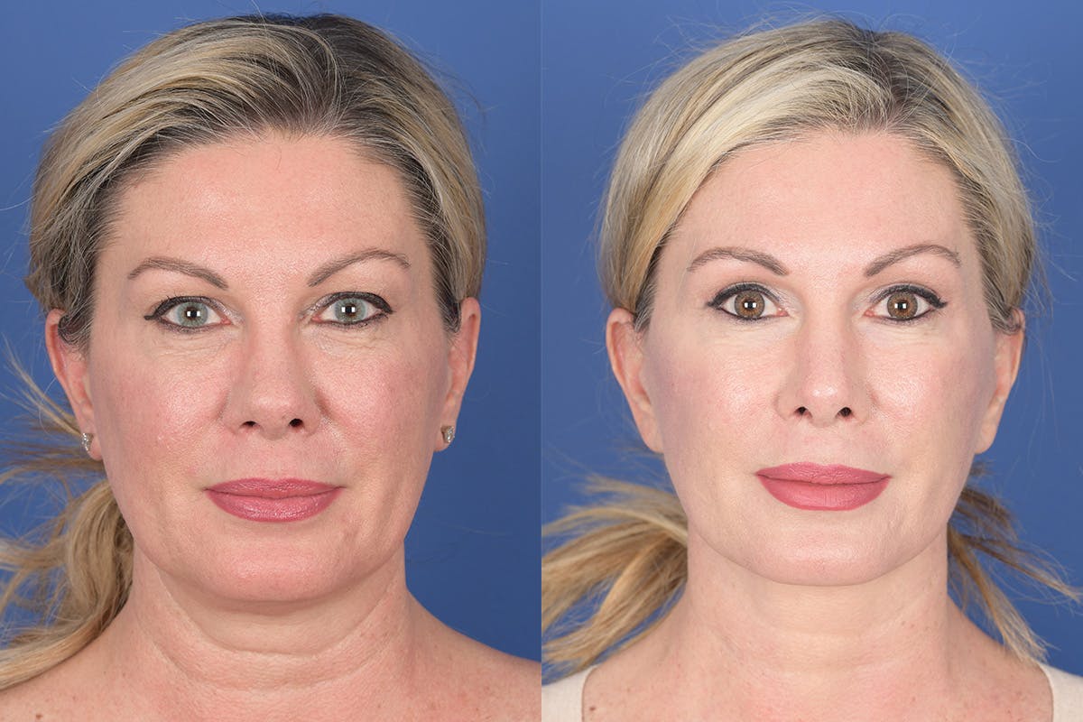 Blepharoplasty Before & After Gallery - Patient 308703 - Image 1
