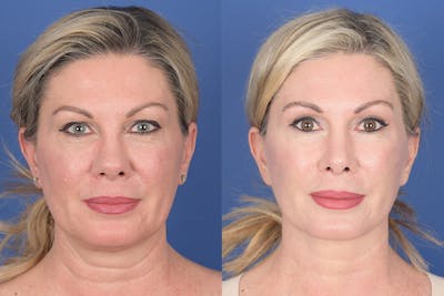 Facelift Before & After Gallery - Patient 141402 - Image 1