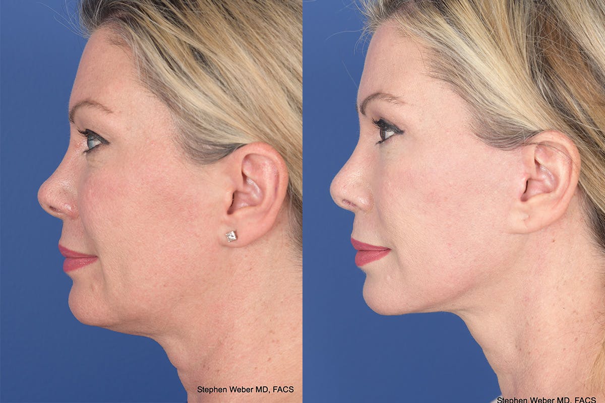 Blepharoplasty Before & After Gallery - Patient 308703 - Image 2