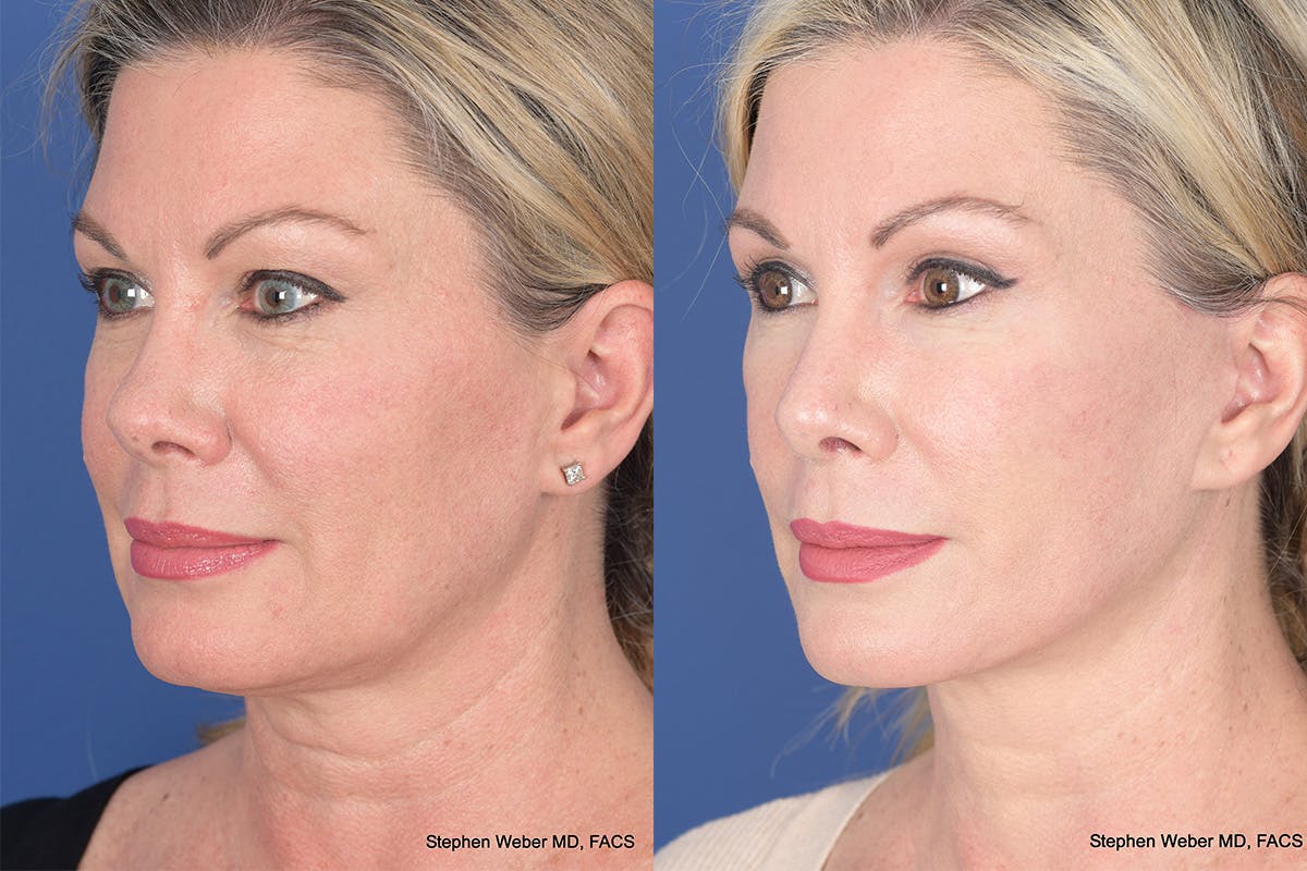Blepharoplasty Before & After Gallery - Patient 308703 - Image 3