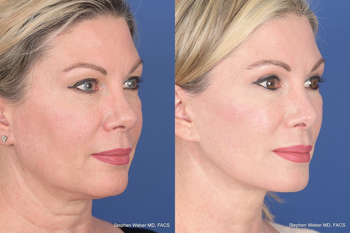Blepharoplasty Before & After Gallery - Patient 308703 - Image 4