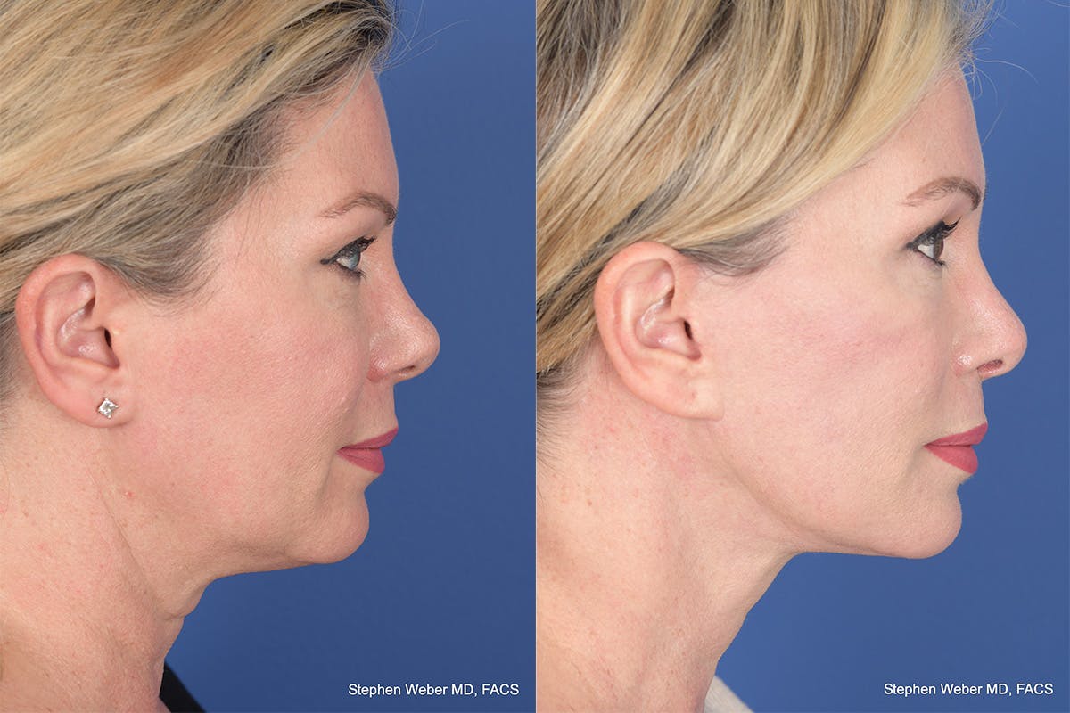 Blepharoplasty Before & After Gallery - Patient 308703 - Image 5