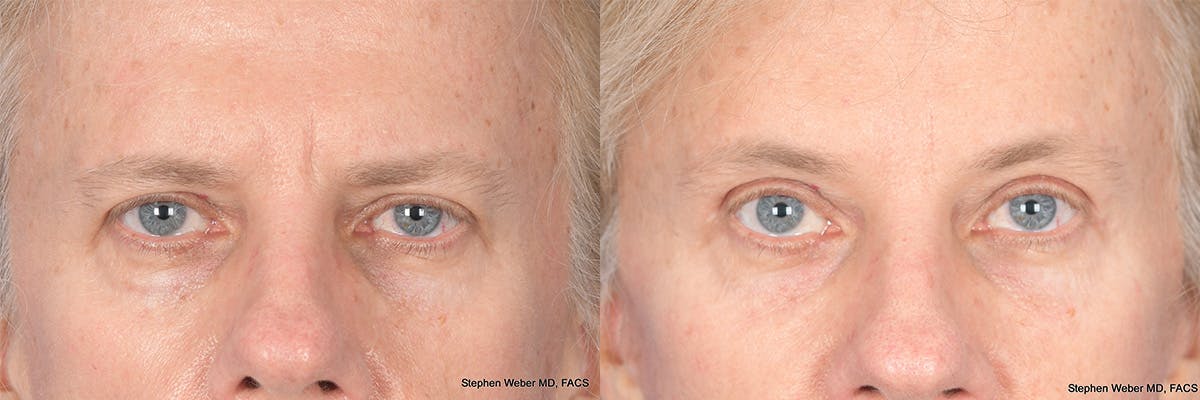 Brow Lift Before & After Gallery - Patient 220296 - Image 1