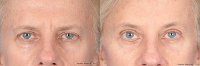 Blepharoplasty Before & After Gallery - Patient 301007 - Image 1