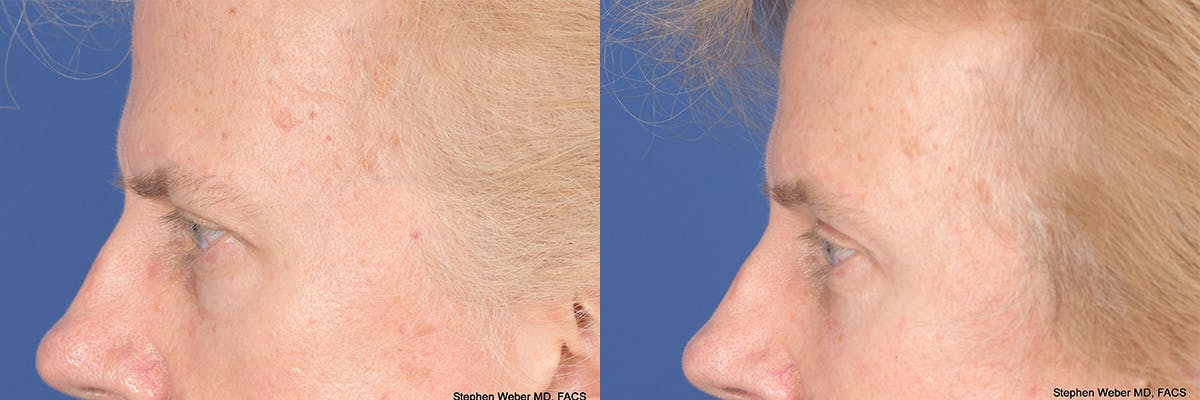 Brow Lift Before & After Gallery - Patient 220296 - Image 2
