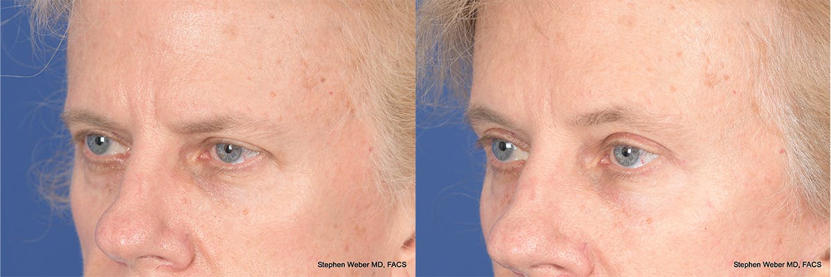 Brow Lift Before & After Gallery - Patient 220296 - Image 3
