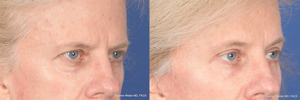 Brow Lift Before & After Gallery - Patient 220296 - Image 4