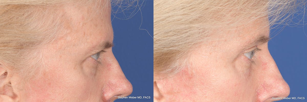 Brow Lift Before & After Gallery - Patient 220296 - Image 5