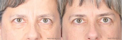 Blepharoplasty Before & After Gallery - Patient 325114 - Image 1