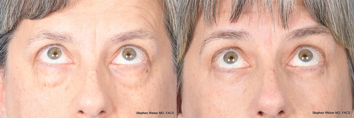 Blepharoplasty Before & After Gallery - Patient 325114 - Image 2