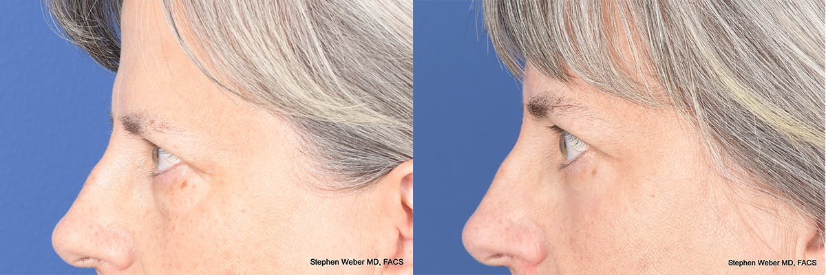Blepharoplasty Before & After Gallery - Patient 325114 - Image 3
