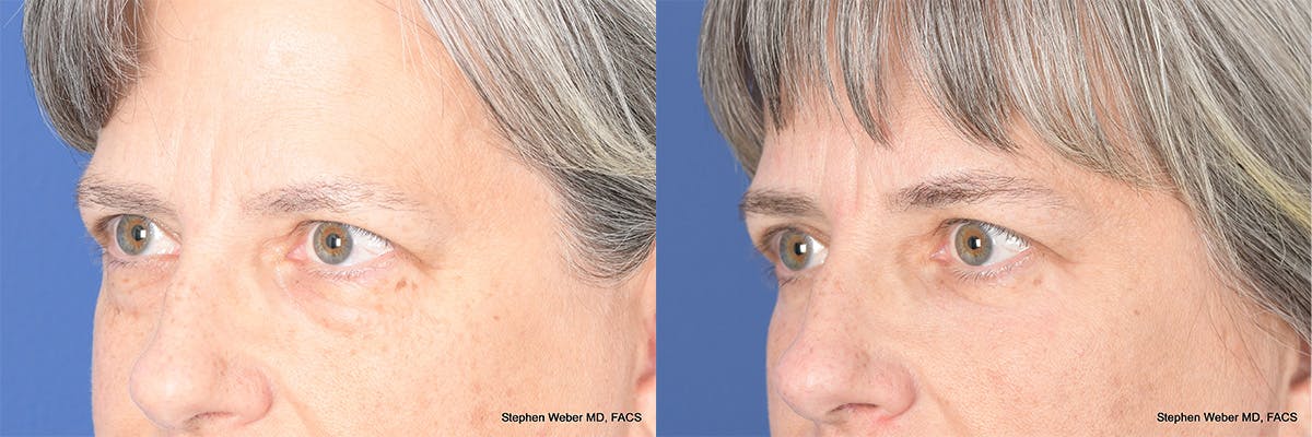 Blepharoplasty Before & After Gallery - Patient 325114 - Image 4