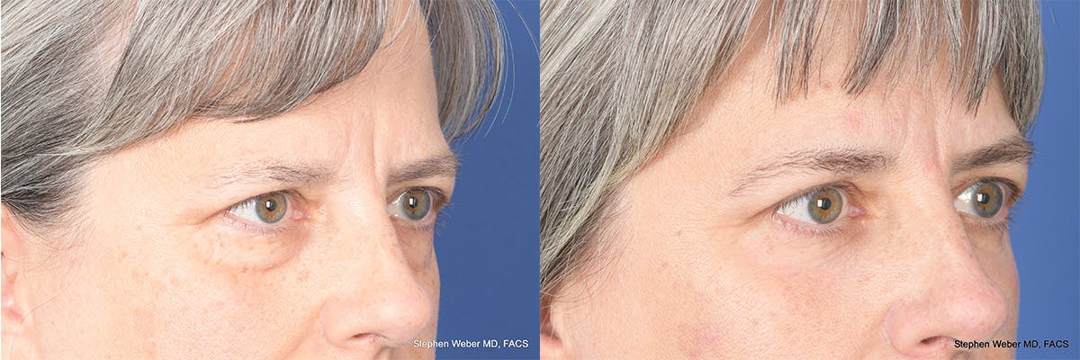 Blepharoplasty Before & After Gallery - Patient 325114 - Image 5