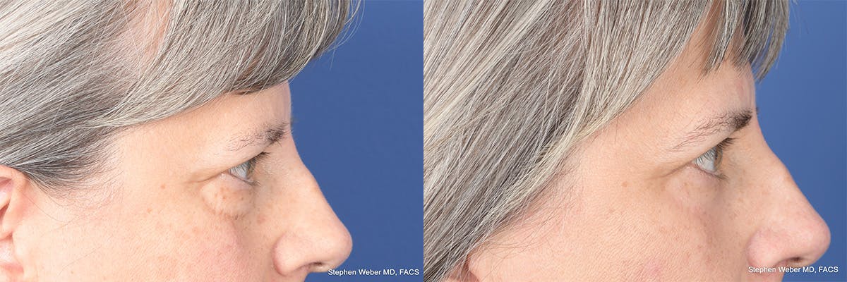 Blepharoplasty Before & After Gallery - Patient 325114 - Image 6