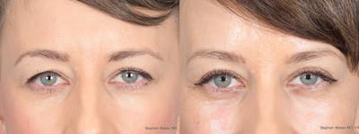 Blepharoplasty Before & After Gallery - Patient 239712 - Image 1