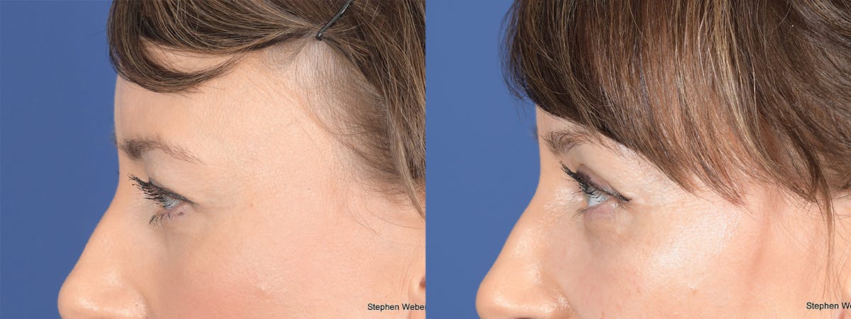 Blepharoplasty Before & After Gallery - Patient 239712 - Image 2