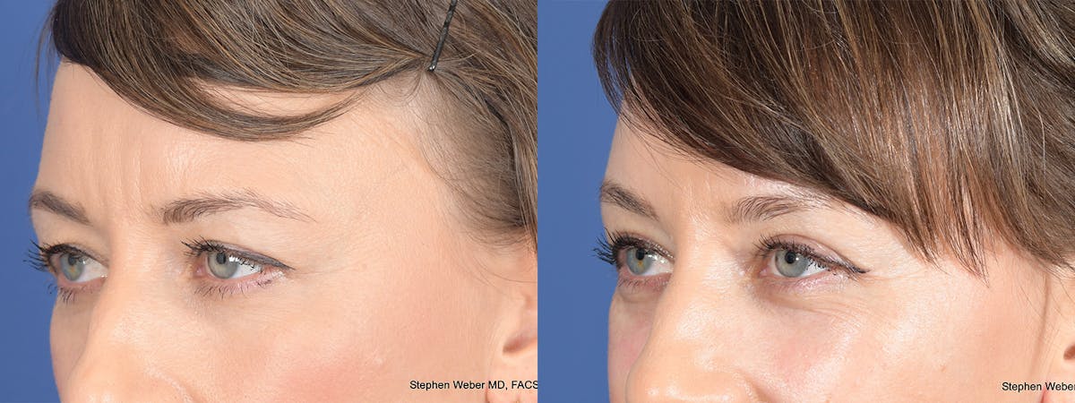 Blepharoplasty Before & After Gallery - Patient 239712 - Image 3
