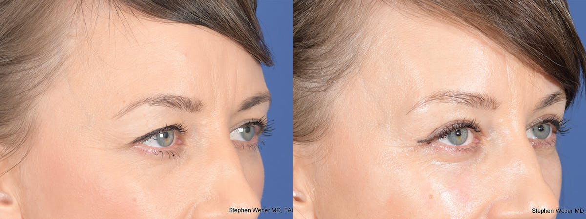 Blepharoplasty Before & After Gallery - Patient 239712 - Image 4