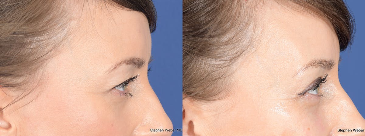 Blepharoplasty Before & After Gallery - Patient 239712 - Image 5