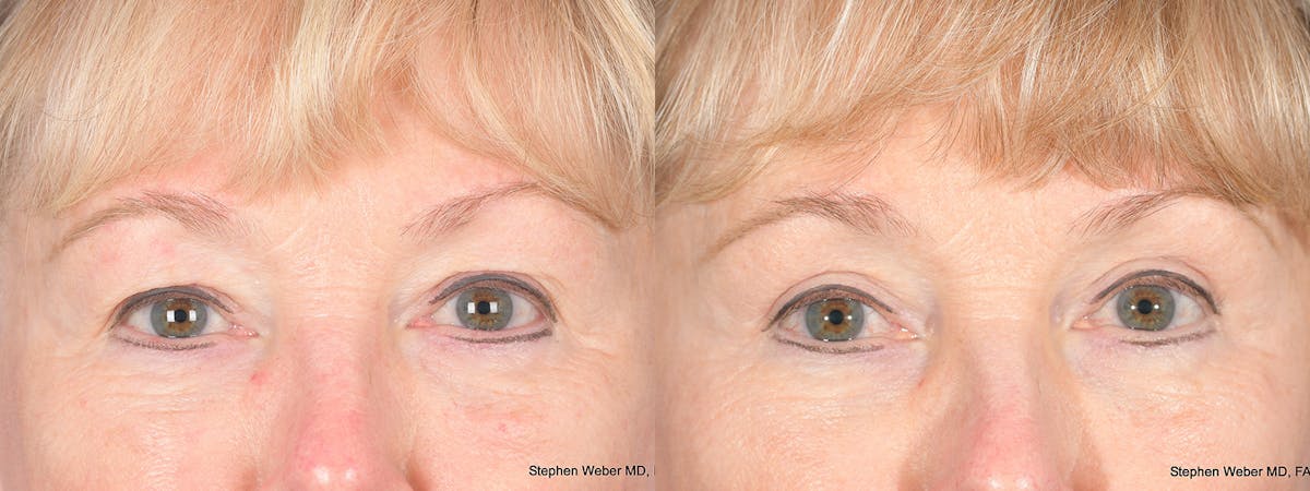 Blepharoplasty Before & After Gallery - Patient 521217 - Image 1