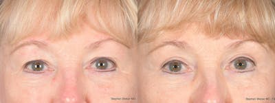 Blepharoplasty Before & After Gallery - Patient 521217 - Image 1